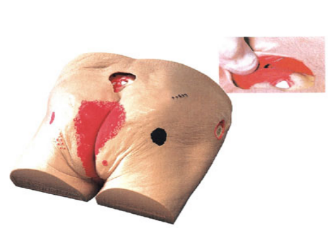 压疮(褥疮)护理模型